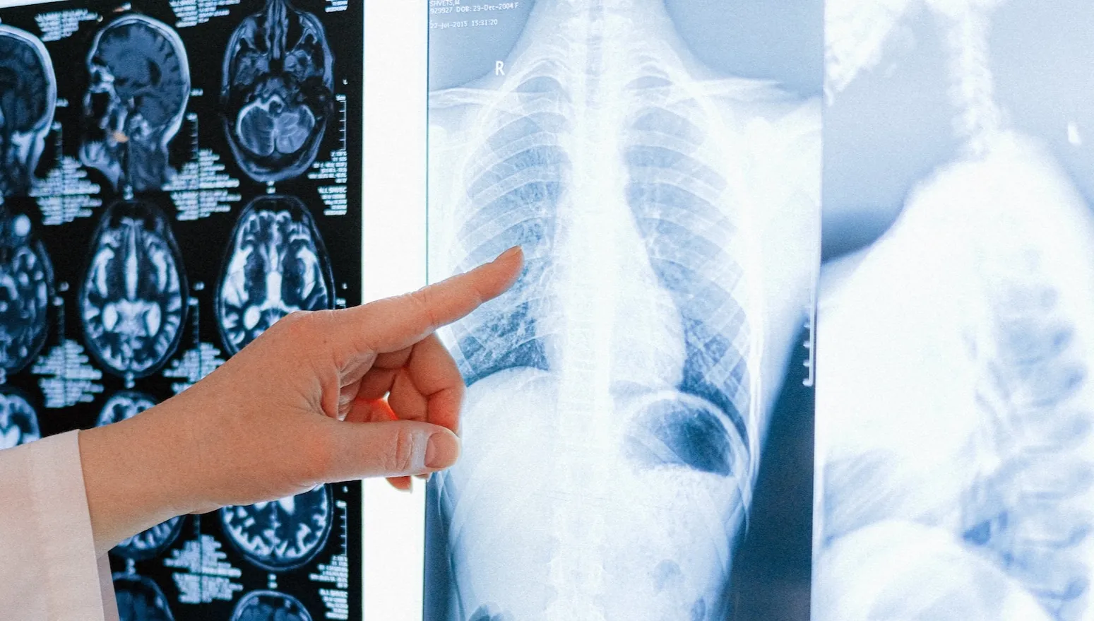 Ryzyko zachorowania na raka płuc zależy od… genów