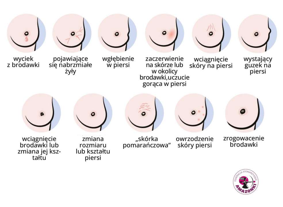 Co powinno zaniepokoić w samobadaniu piersi?